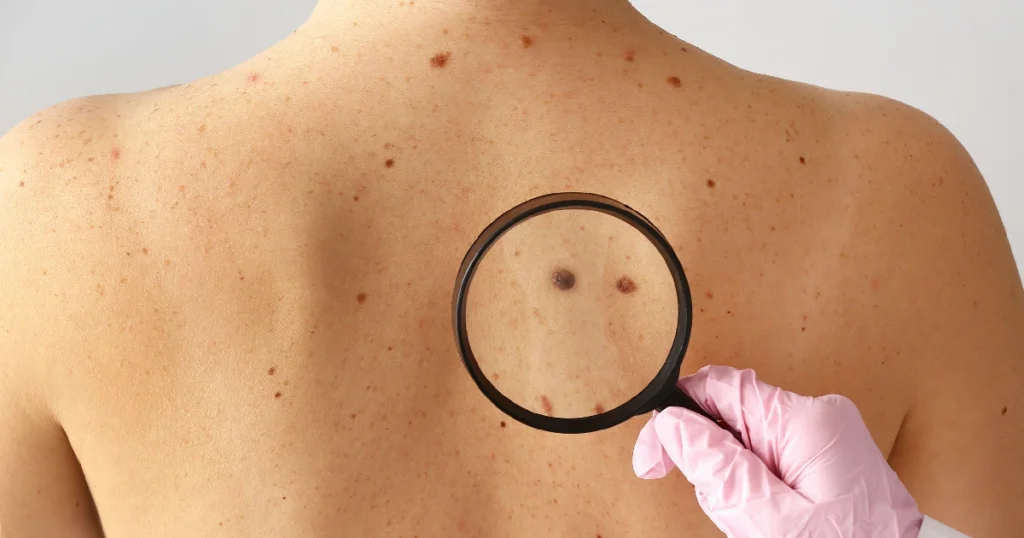 A doctor examining the signs of skin cancer in Owensboro, KY
