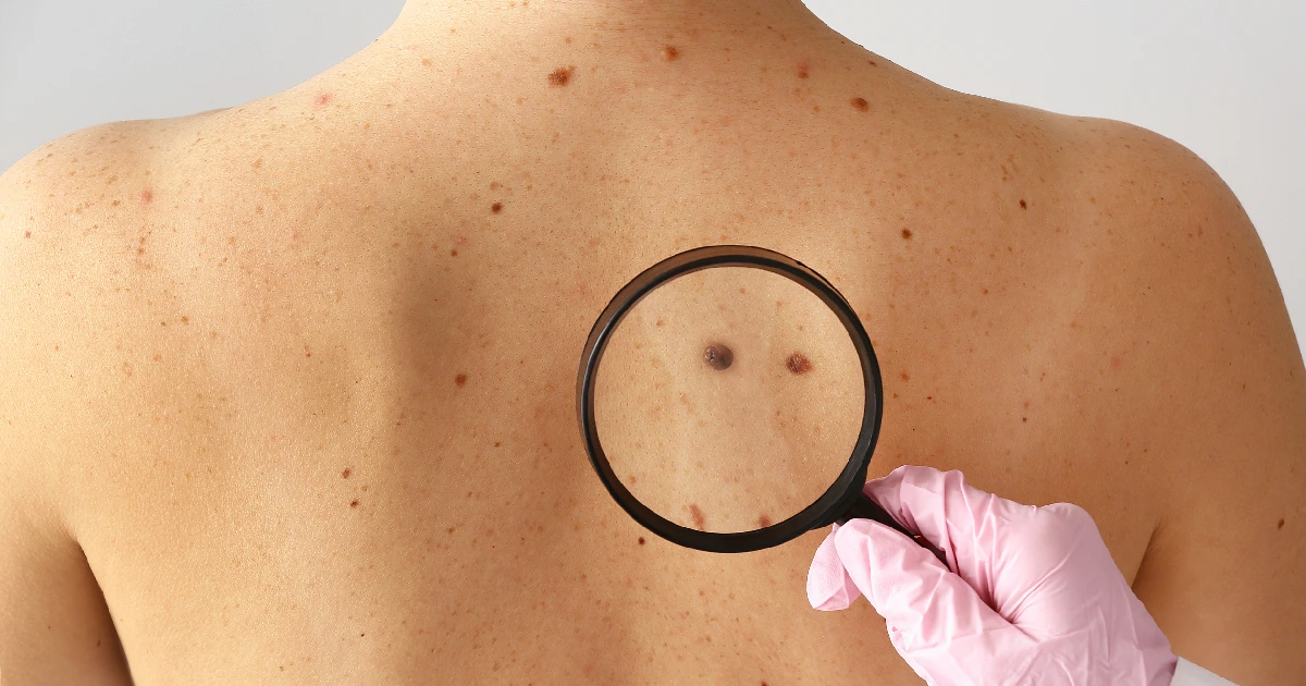 A doctor examining the signs of skin cancer in Owensboro, KY