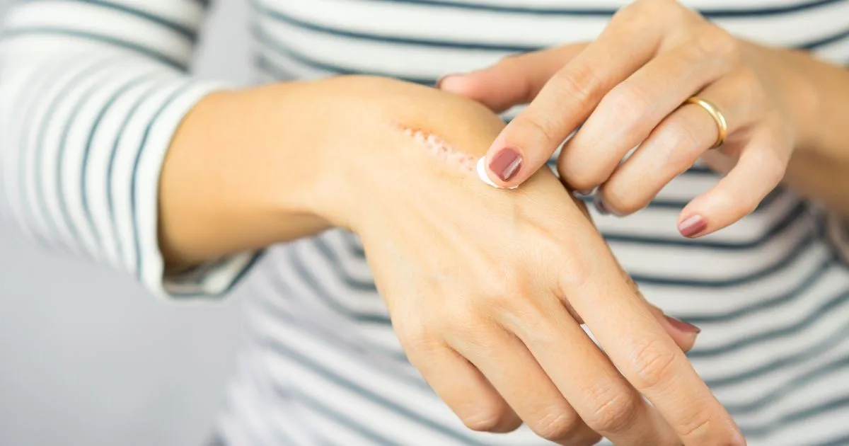 Provider applying a topical treatment (like a chemical peel or pre-treatment) for scar revision, emphasizing a comfortable process using ProNox