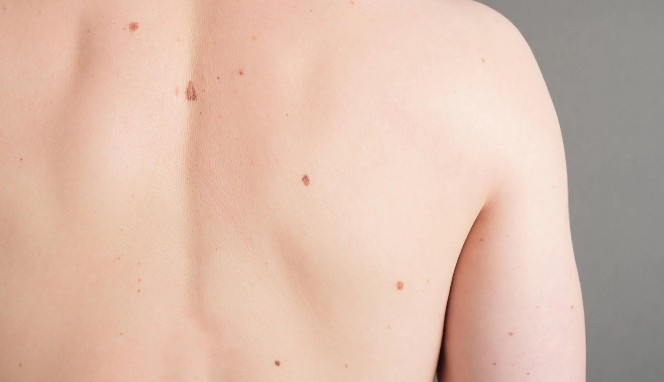 Skin-Cancer-Prevention-Service-Skin-Cancer-And-Laser-Surgery-Center Newburgh, IN | Owensboro Dermatology