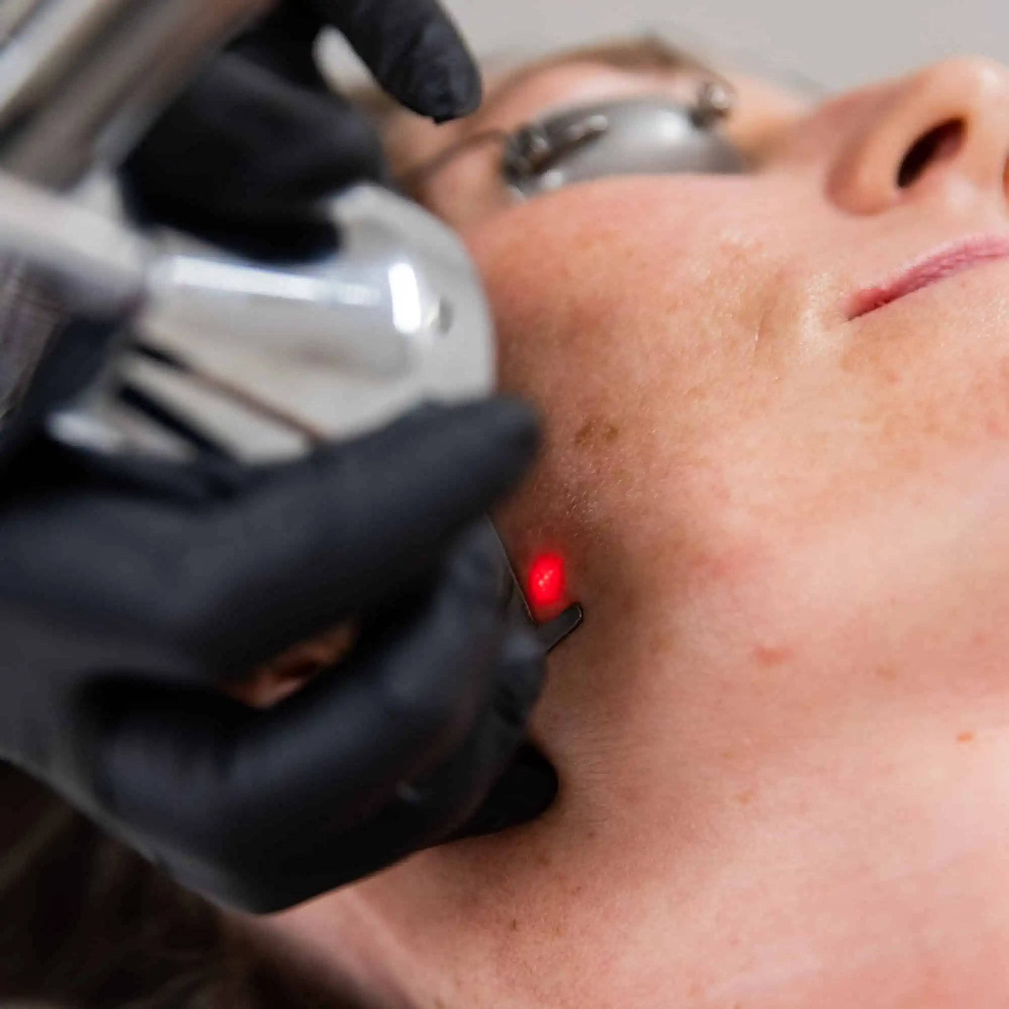 Profractional-Treatment-Service-Owenboro-Newburgh-Henderson-Advanced-Aesthetics in Owensboro, KY | Owensboro Dermatology