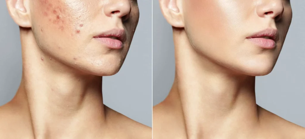 Acne-Treatment-by-Owensboro-Dermatology-Associates-PSC-in-Owensboro-KY | Owensboro Dermatology