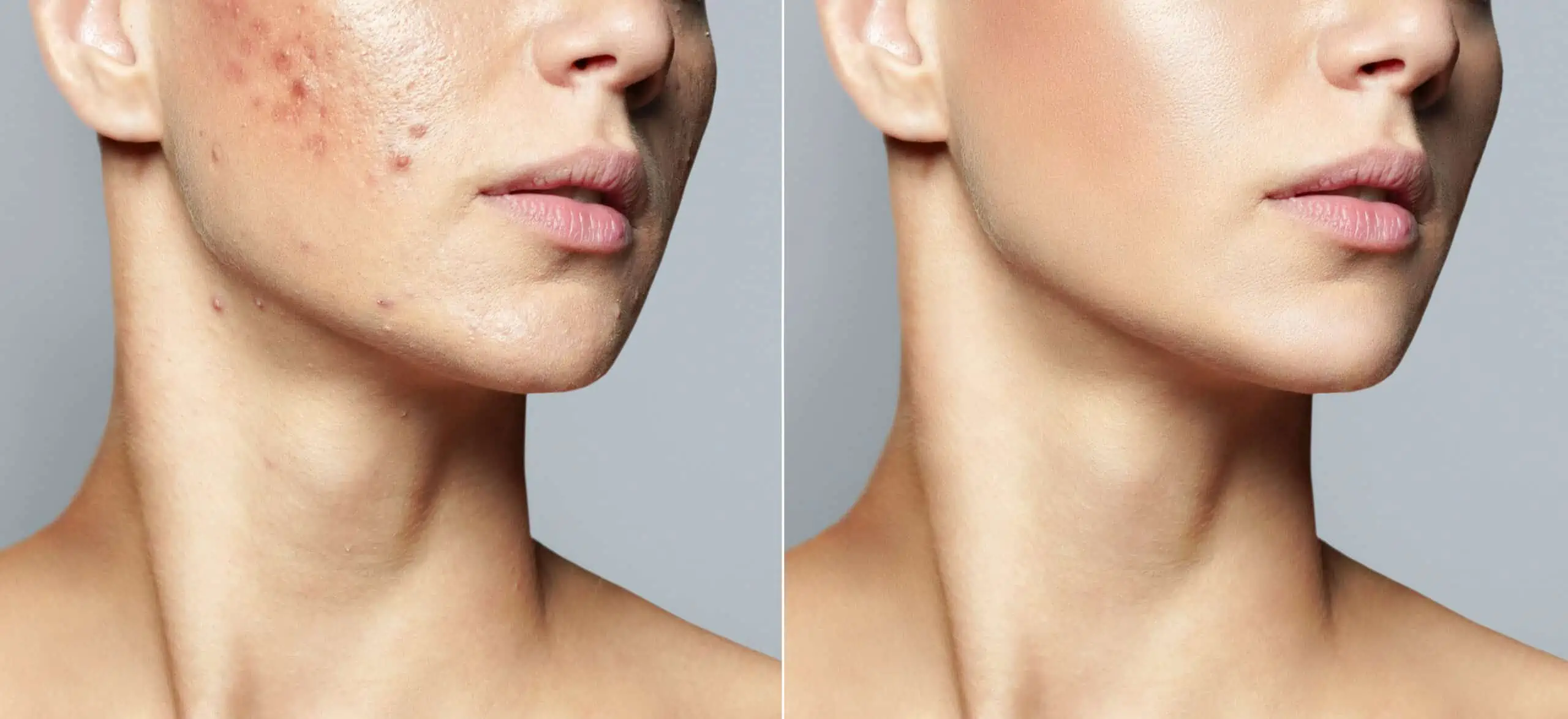 Acne-Treatment-by-Owensboro-Dermatology-Associates-PSC-in-Owensboro-KY | Owensboro Dermatology