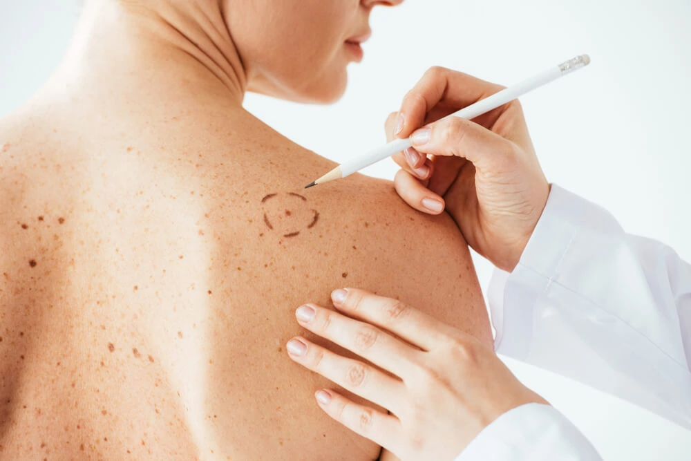 kin-Lesions-And-Growths-Home-by-Our-Family-Derm-in-Owensboro-Newburgh-Henderson-Advanced-Aesthetics in Owensboro, KY | Owensboro Dermatology
